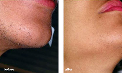 laser-hair-removal-before-after-female1